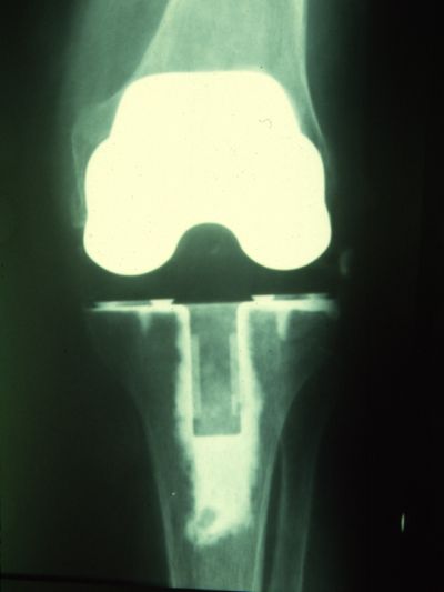 Knee Prosthesis, Total:  Unidentified (Implant 162)